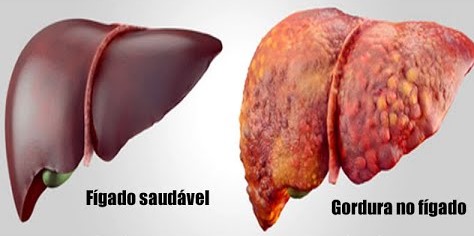 Gordura no Fígado