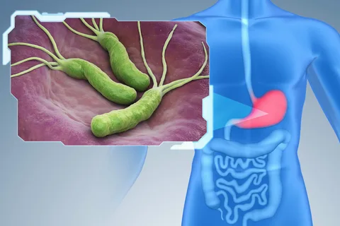 H pylori